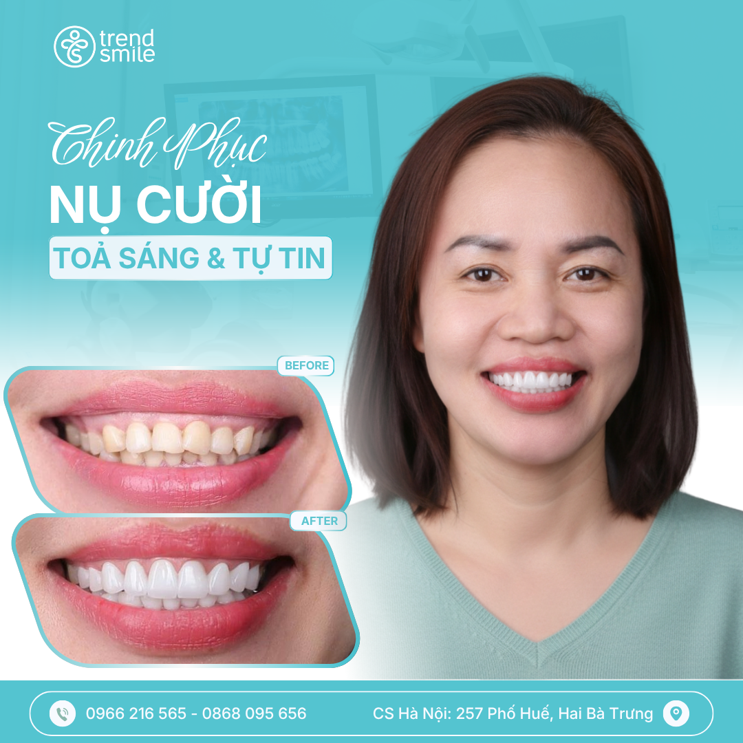 dán sứ veneer
