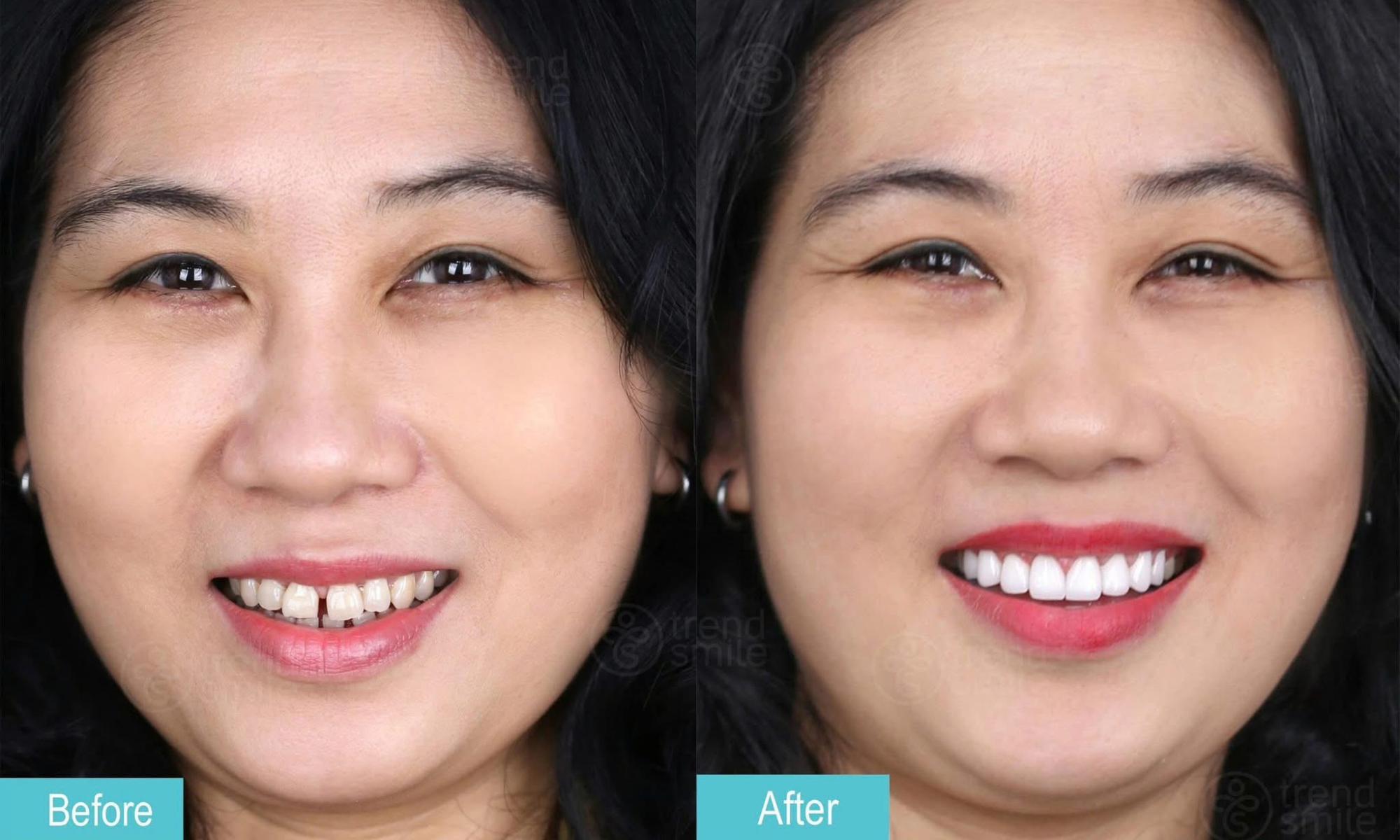 Khách hàng trend smile